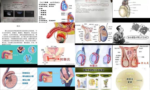 汕头附睾炎症状