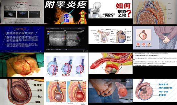 汕头睾丸附睾炎