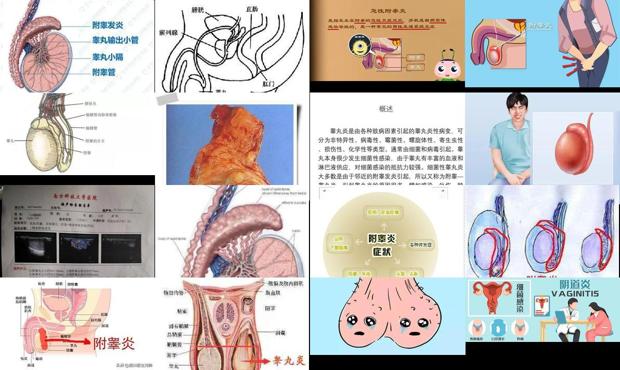 汕头附睾炎的症状