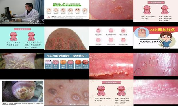 汕头龟头炎的症状图片资料