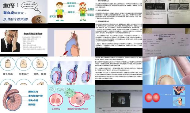 汕头睾丸炎图片