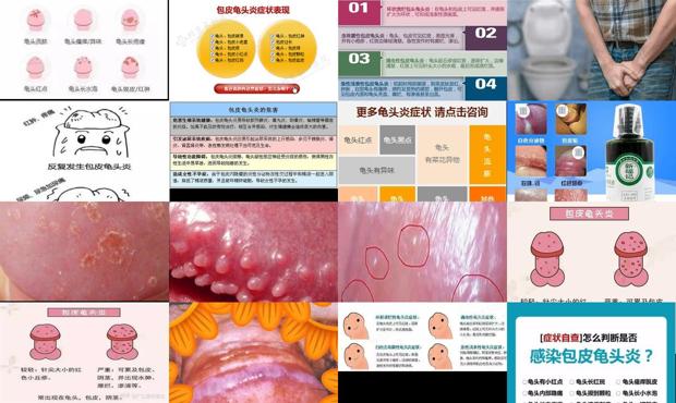 汕头怎么判断是不是龟头炎图片