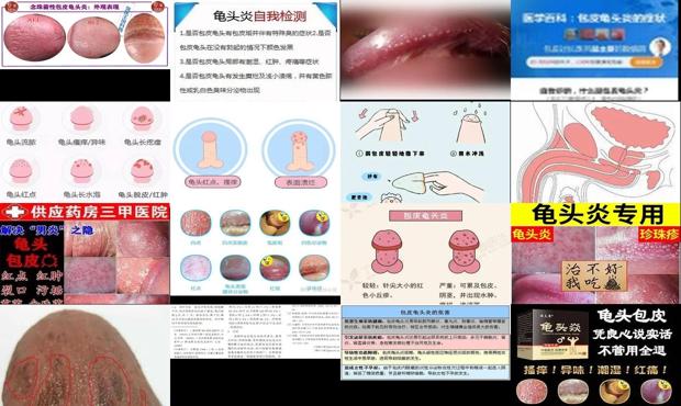 汕头包皮龟头炎的自我治疗