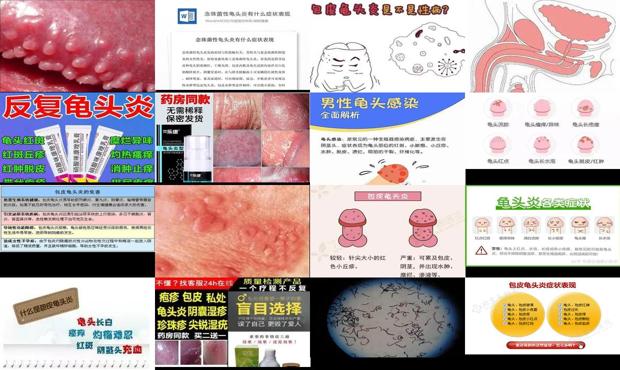 汕头龟头炎是什么