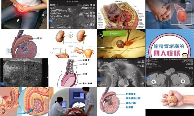 汕头睾丸炎症