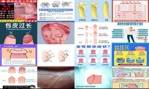 汕头包皮炎症图片