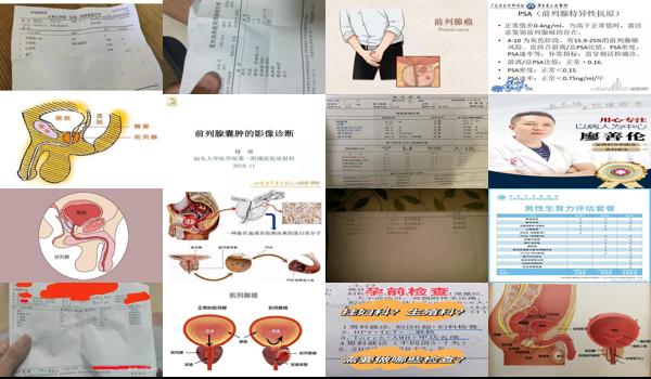 汕头中心医院前列腺检查多少钱一次 - 汕头前列腺查什么科